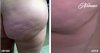 pic-cellulite-before-after.jpg